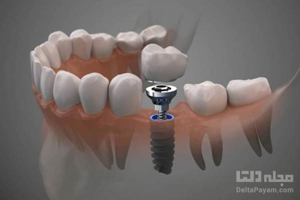 دندان مصنوعی یا ایمپلنت؟ کدام برای شما مناسب تر است؟